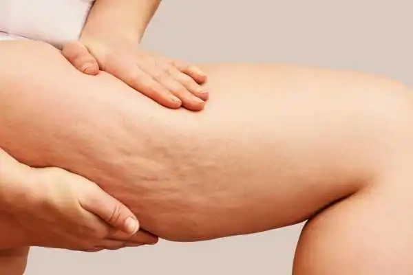 Image of woman showing leg with cellulite Basildon