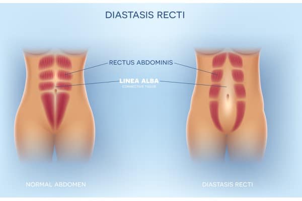 What Non-Surgical Options Are Available for Diastasis Recti Basildon?