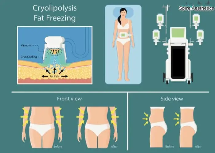 Fat freezing treatment Basildon benefits for competitions to remove stubborn fat deposits.