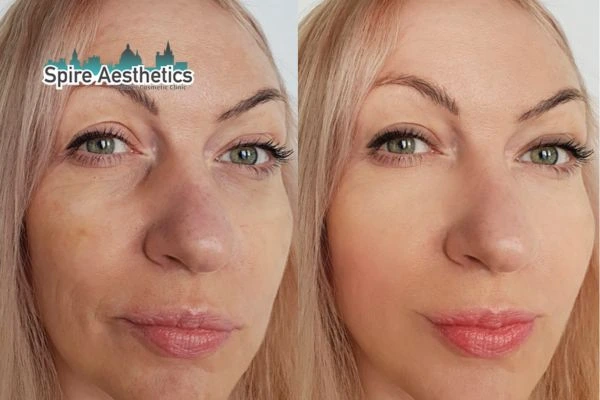 Morpheus8 Treatment Basildon Before & After Results