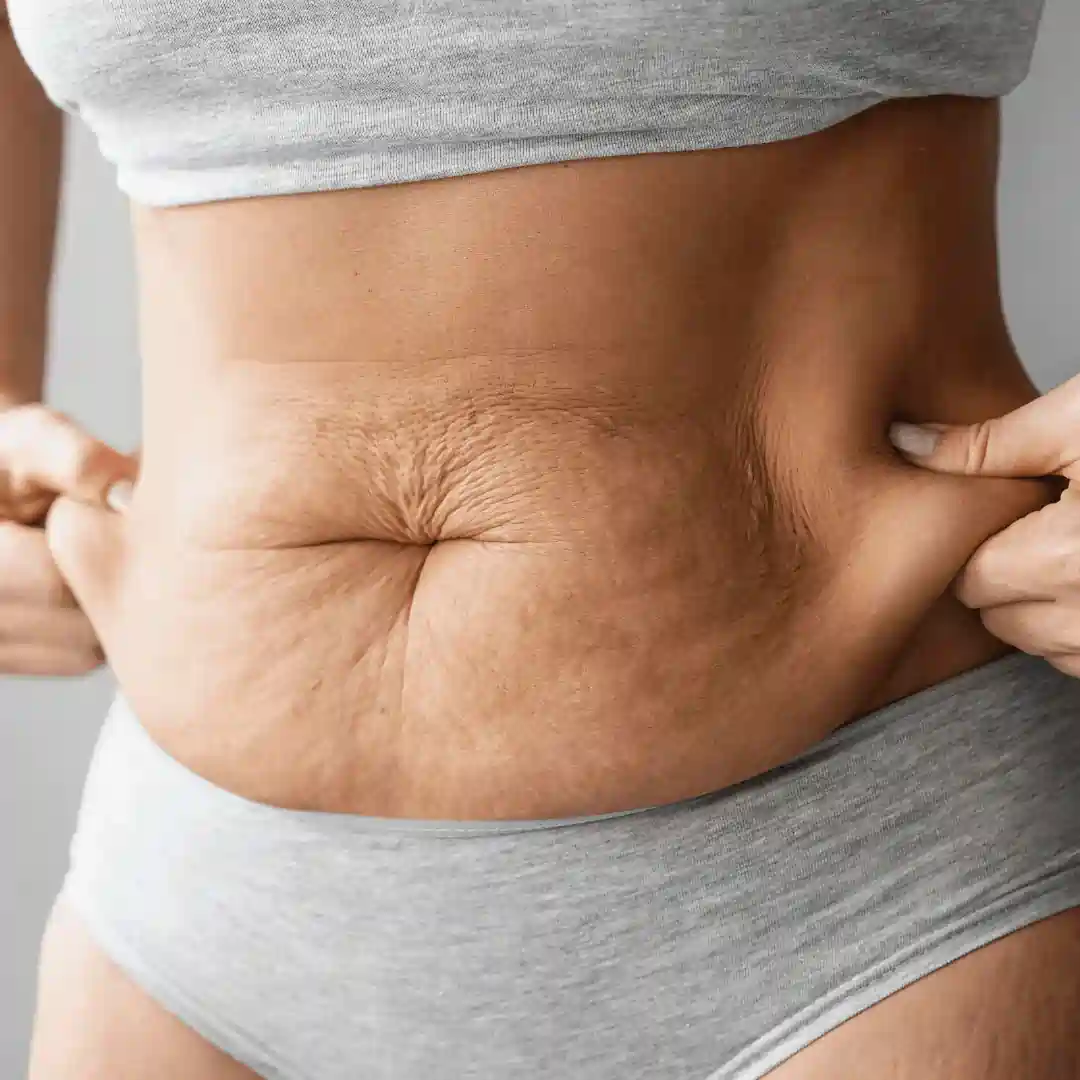 Is It Normal to Have Loose Skin After Pregnancy Basildon?