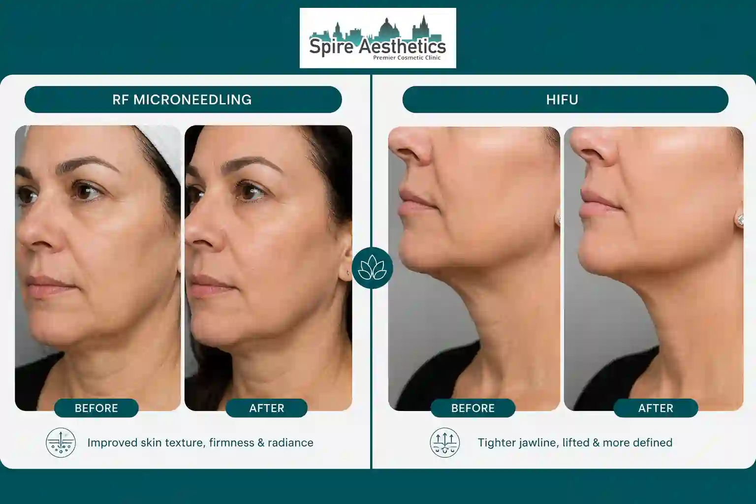 Can RF Microneedling and HIFU Be Combined Basildon?
