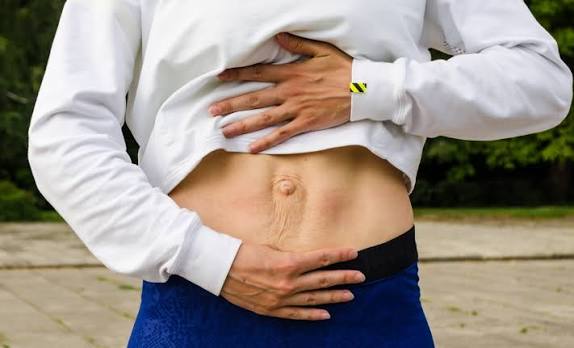 When Could Diastasis Recti Be the Missing Piece of the Puzzle Basildon?