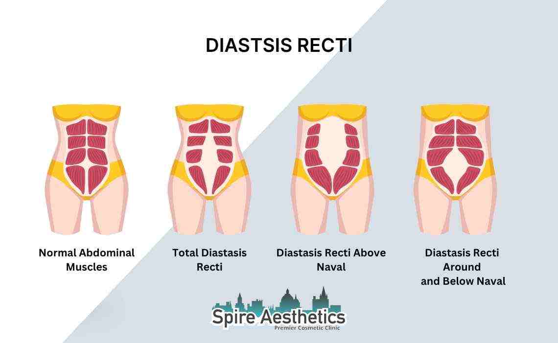 Is Non-Surgical Diastasis Recti Treatment Right for You? Common Concerns Answered Basildon